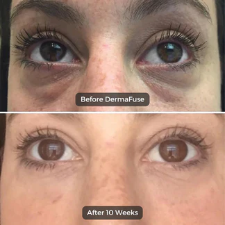Vorexil™ Micro-Needle Under-Eye Patches for Brighter, Smoother Looking Eyes