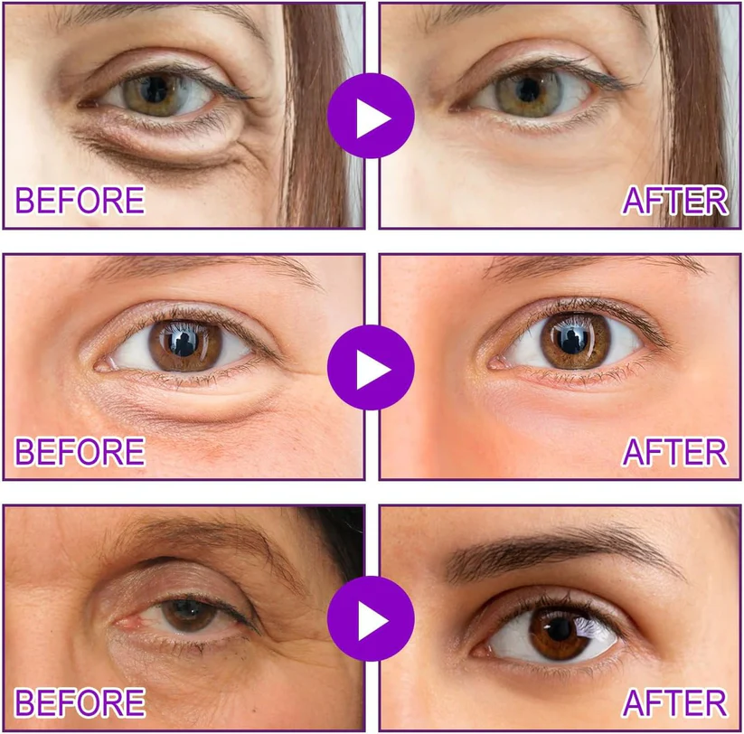 Vorexil™ Micro-Needle Under-Eye Patches for Brighter, Smoother Looking Eyes