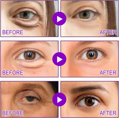 Vorexil™ Micro-Needle Under-Eye Patches for Brighter, Smoother Looking Eyes