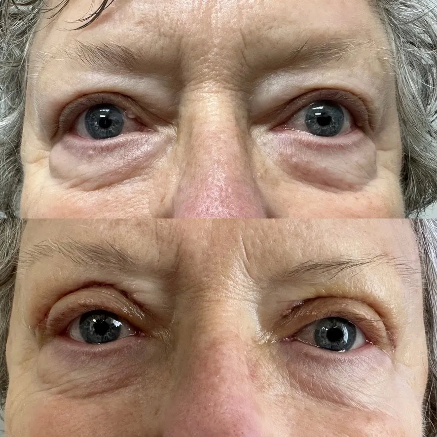 Vorexil™ Micro-Needle Under-Eye Patches for Brighter, Smoother Looking Eyes