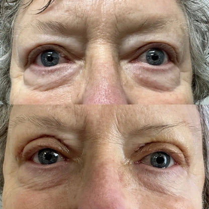 Vorexil™ Micro-Needle Under-Eye Patches for Brighter, Smoother Looking Eyes