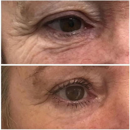 Vorexil™ Micro-Needle Under-Eye Patches for Brighter, Smoother Looking Eyes