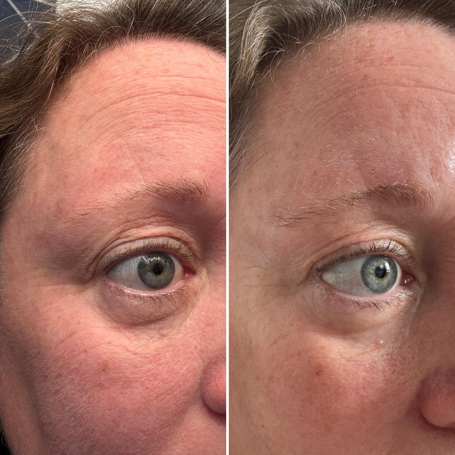Vorexil™ Micro-Needle Under-Eye Patches for Brighter, Smoother Looking Eyes