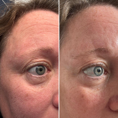 Vorexil™ Micro-Needle Under-Eye Patches for Brighter, Smoother Looking Eyes
