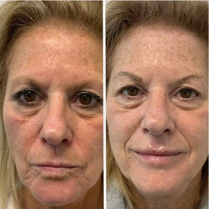 Vorexil™ Micro-Needle Under-Eye Patches for Brighter, Smoother Looking Eyes